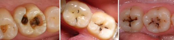 Кариес зубов — причины, симптомы, лечение и профилактика кариеса